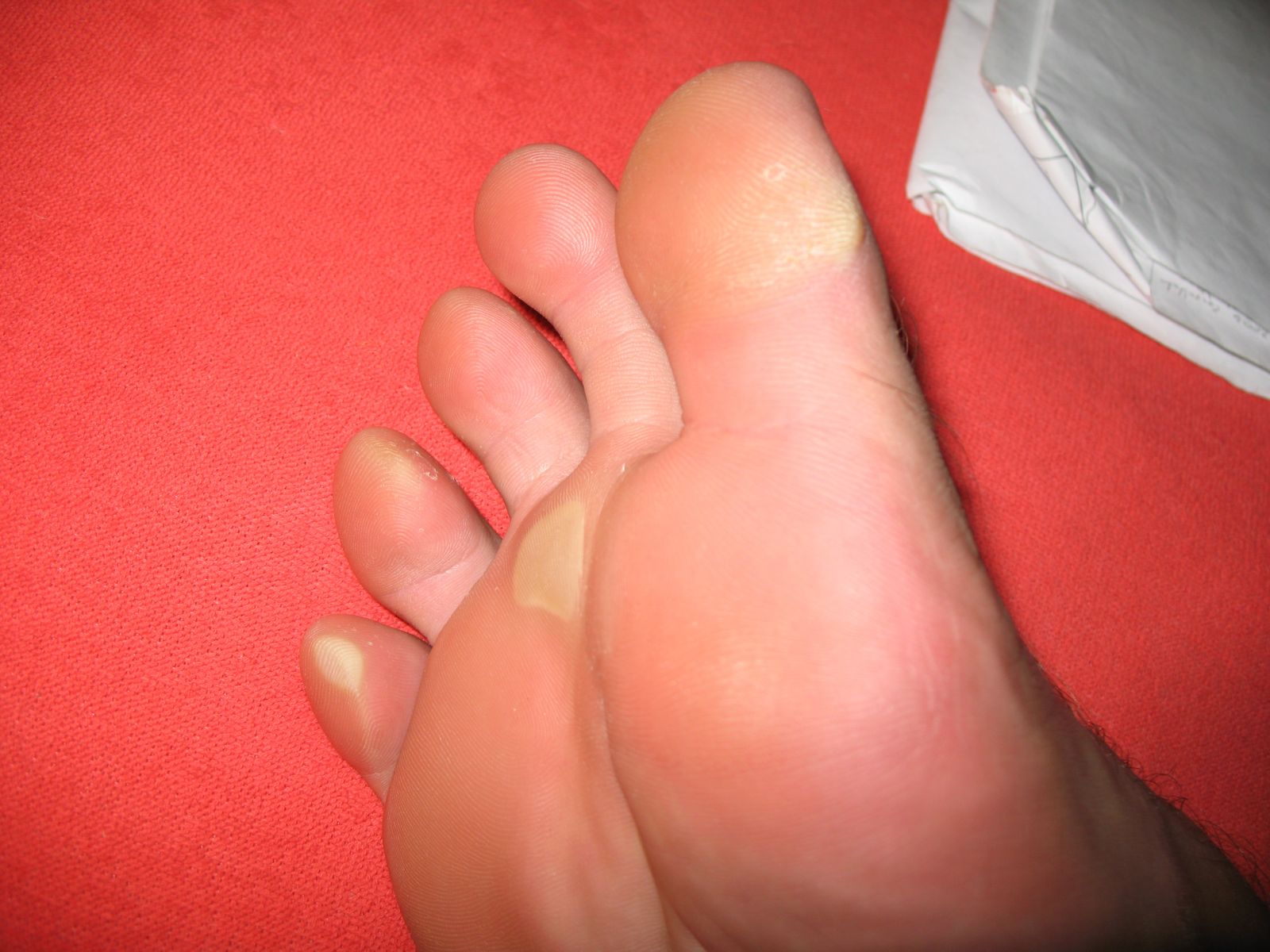 shaving-of-real-big-toe-callus-biggest-toe-callous-ever-full